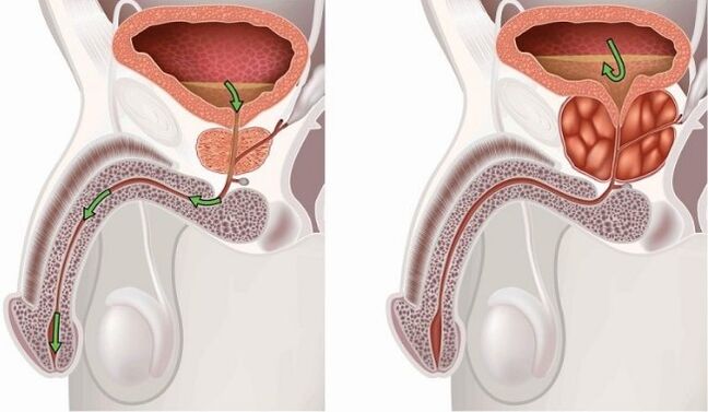 Healthy and painful prostate