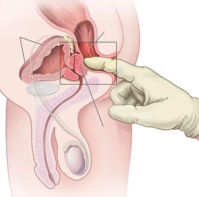 Prostate massage for the treatment of prostatitis