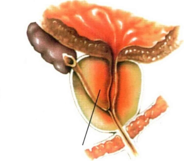 Inflammation of the prostatic tissue in chronic prostatitis